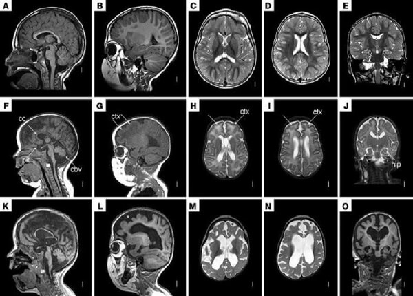 <center><em>Chụp MRI cho trẻ em giúp phát hiện bệnh lý về não bộ</em></center>