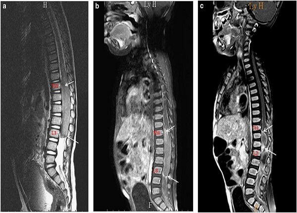 <center><em>Hình ảnh chụp MRI cột sống cho trẻ em phát hiện bất thường</em></center>